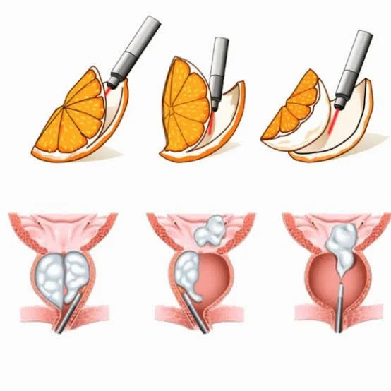 Ilustração de técnica HoLEP